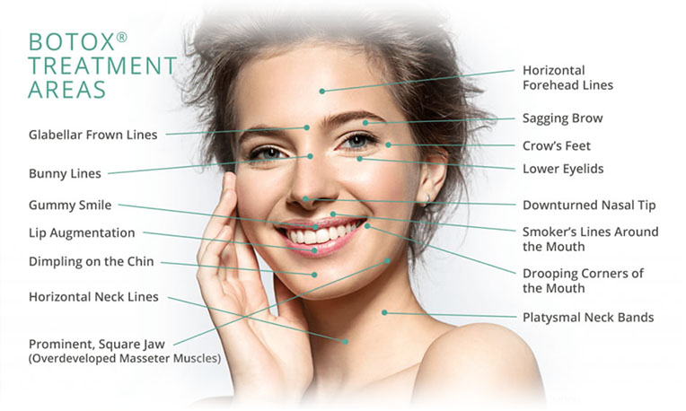 Anti-Wrinkle Treatment Cardiff And Bristol