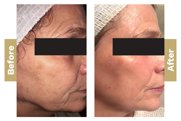 Ageing-and-hyperpigmentation